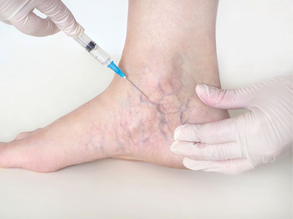Sclerotherapy