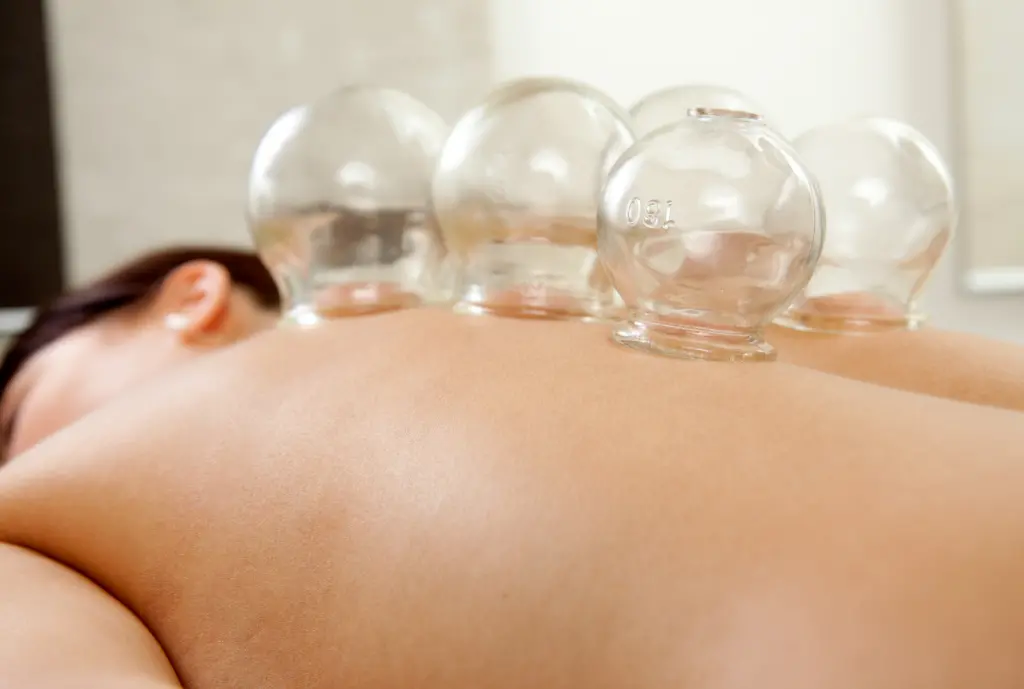 Cupping Therapy