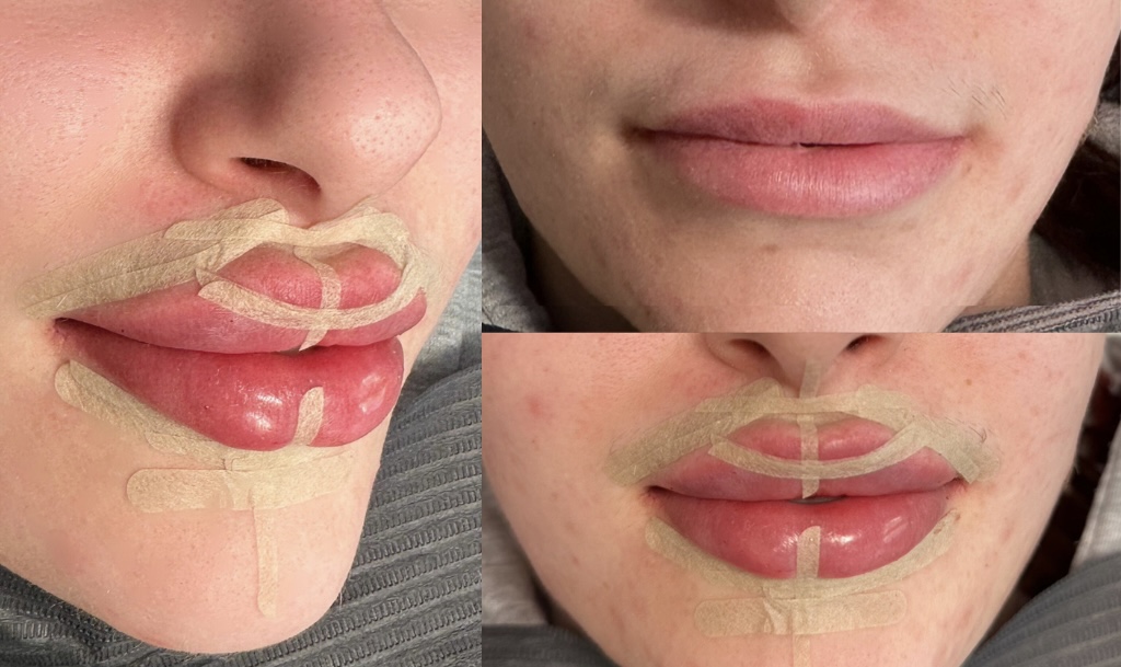 Butterfly Lips (Partial Dissolve & Refill)
