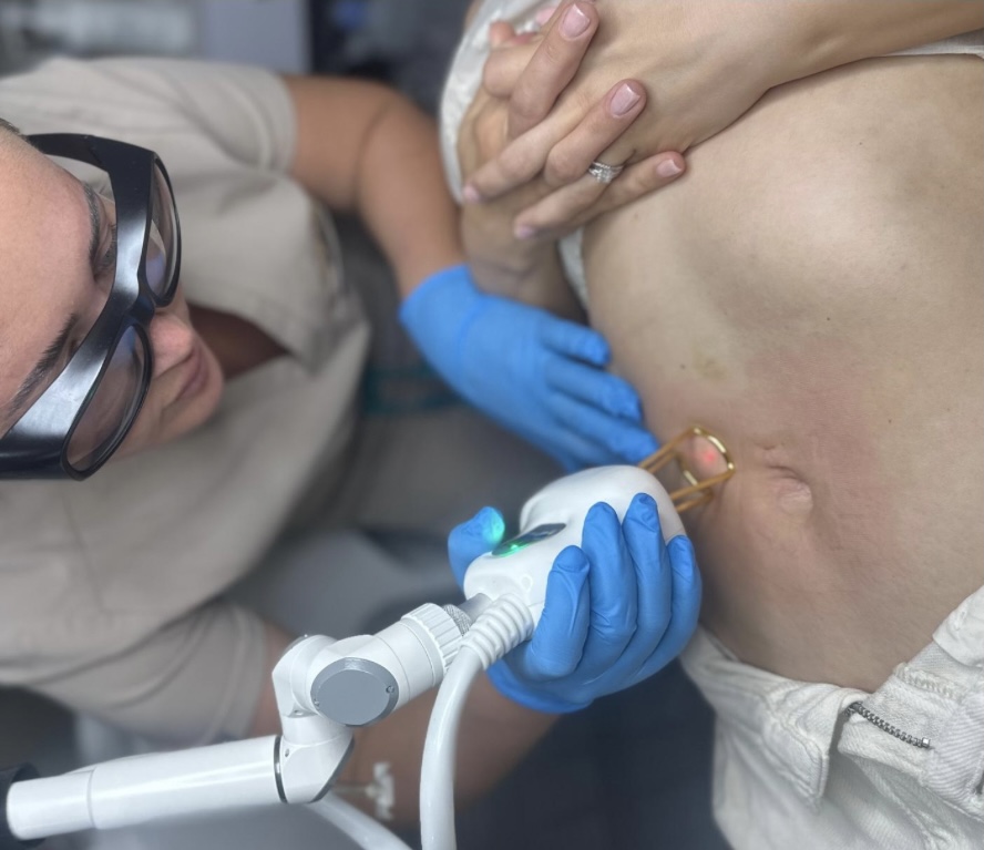 CO2 Laser Skin Resurfacing & Tightening