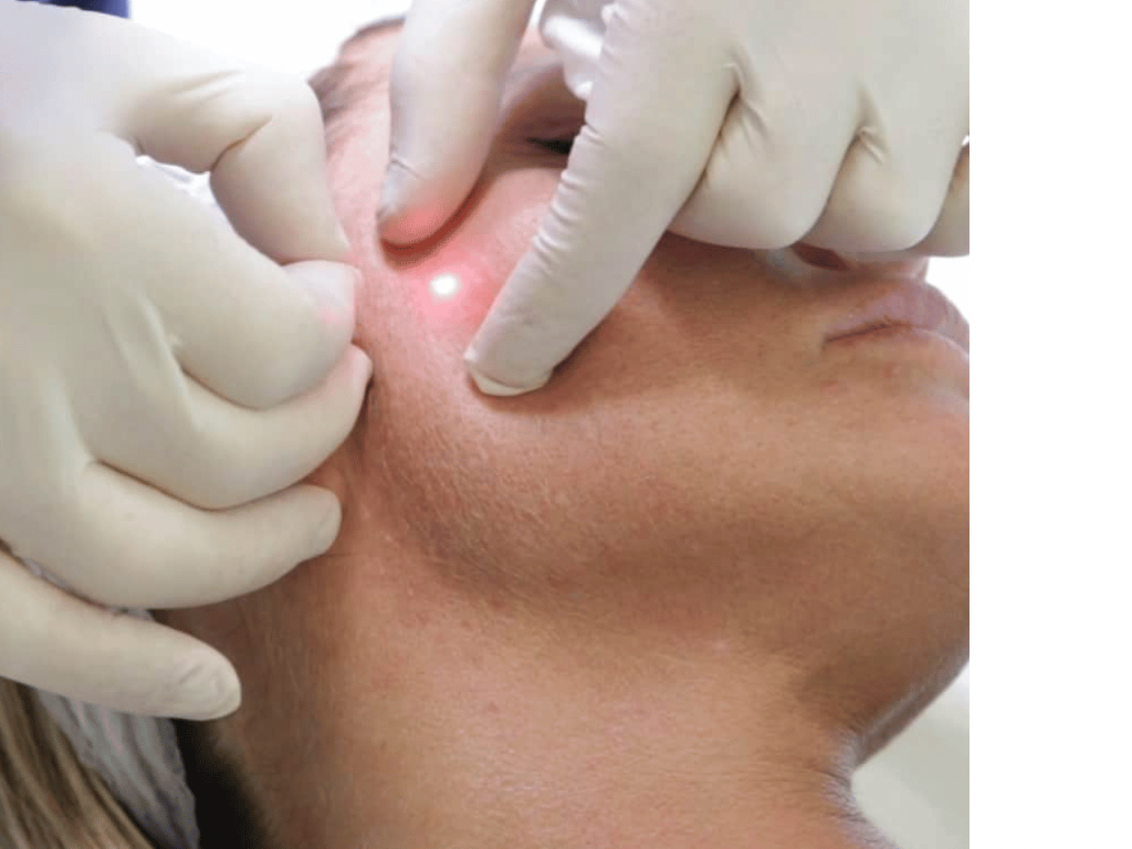 Endo Fibre LaserLift - Advanced Laser Skin Tightening & Contouring